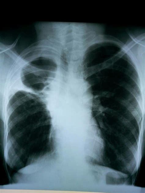 In addition, a diagnostic and therapeutic thoracentesis of a l > r pleural effusion was performed. Loculated pleural effusion | Radiology, Anatomy and ...