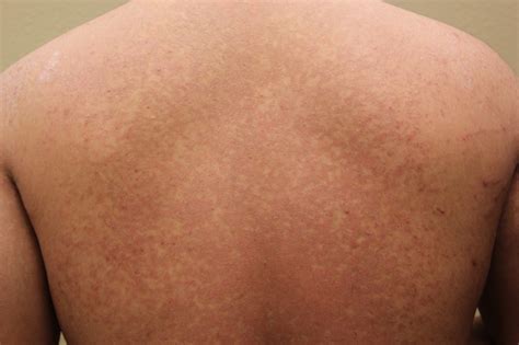 Fungal Skin Infections Back