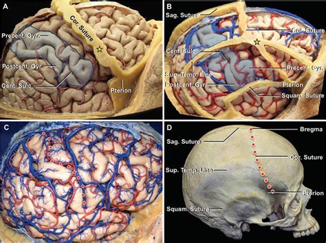 The Coronal Suture And Central Sulcus Neuroanatomy The