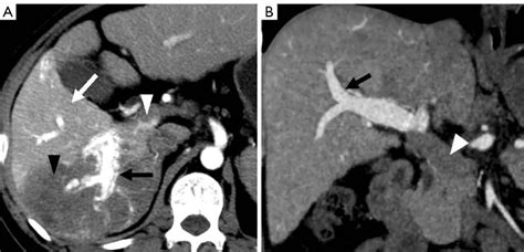 Ct And Mri Imaging And Interpretation Of Hepatic Arterioportal Shunts Pmc