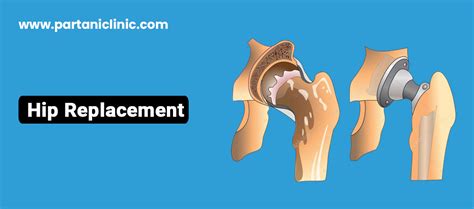 Best Hip Replacement Surgery In Jaipur By Dr Arun Partani Clinic