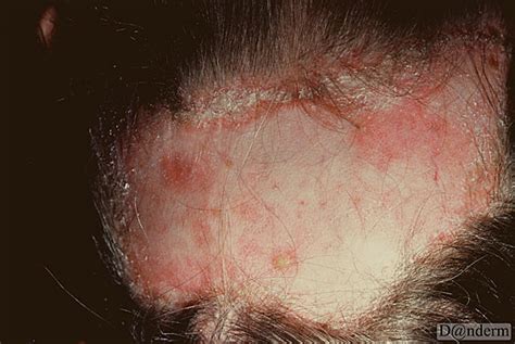 6 15 2 Discoid Lupus Erythematosus Of The Scalp With Scarring Alopecia