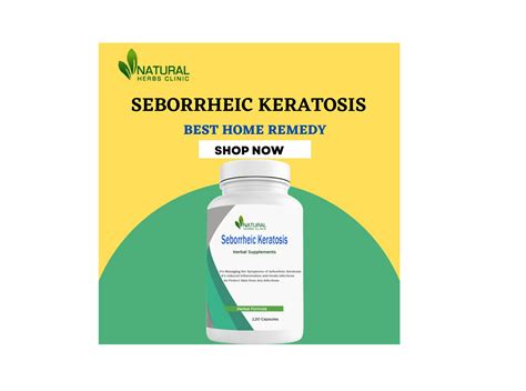 Seborrheic Keratosis Read The Natural Treatments With Detail Atoallinks