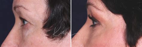 Lower Blepharoplasty Upper Blepharoplasty Photos Voorhees Nj