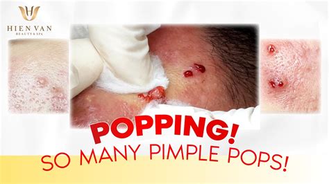 Popping So Many Pimple Pops Điều Trị Mụn Hiệu Quả Nhất Tphcm Tại Hiền