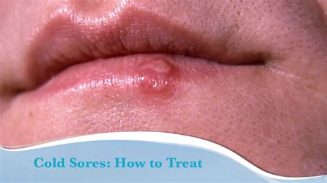 How To Get Rid Of A Cold Sore Temporaryatmosphere32