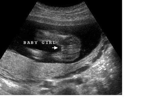 Its A Girl Ultrasound 16 Weeks