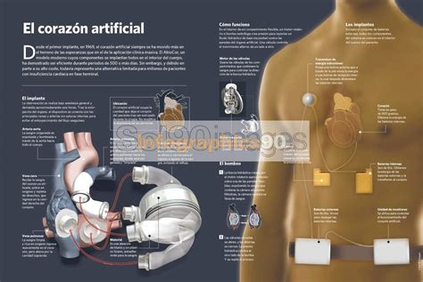 Infografía El Corazón Artificial Infographics90