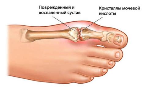Arthrosis Of The Joints Of The Big Toe Of The Foot
