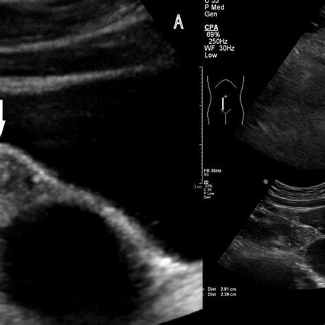 Pdf Isolated Fallopian Tube Torsion With Fimbrial Cyst In A 10 Year