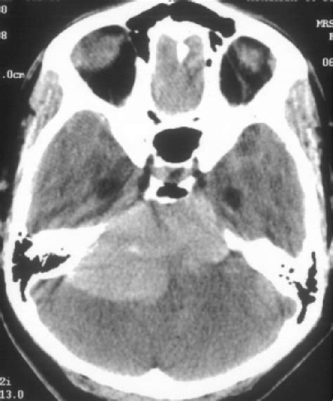 Figure 1 From Unusual Appearances Of White Epidermoid Cyst On Ct And