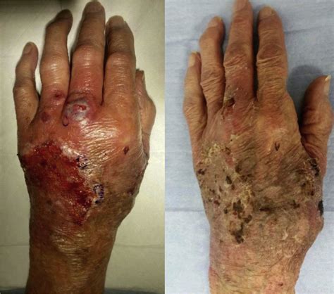Neutrophilic Dermatosis Of The Hands A Review Of 17 Cases Journal Of