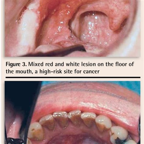 Asymptomatic Red Erythroplakic Lesion Involving The Soft Palate And