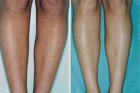 Red Bumps After Laser Hair Removal On Legs Best Hairstyles Ideas For