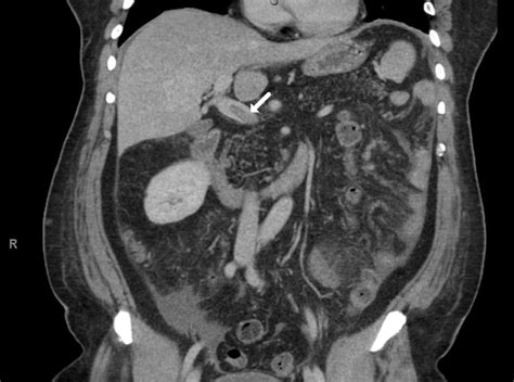 An Unusual Case Of Epigastric Pain The Bmj