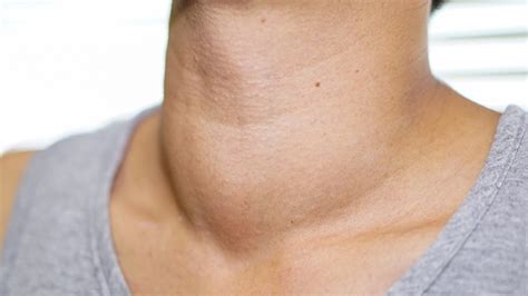 Diet And Home Remedies For Goiter Chandigarh Ayurved And Panchakarma Centre