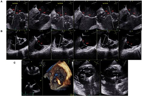 Frontiers A Practical Approach To Combined Transcatheter Mitral And