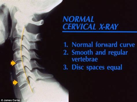 This Is An Example Of A Normal Cervical X Ray With A Forward Curve And