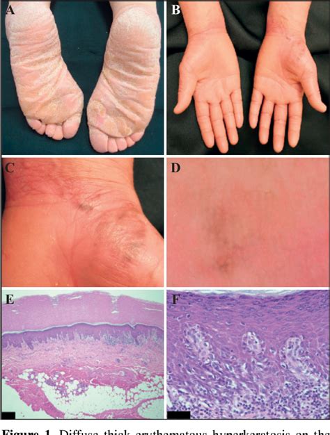 Figure From Malignant Melanoma Arising In The Skin Lesions Of Nagashima Type Palmoplantar