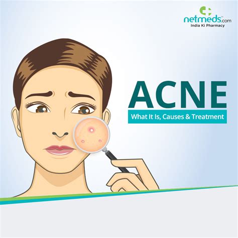 Acne Causes And Treatment