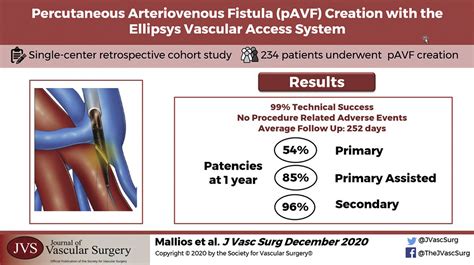 Midterm Results Of Percutaneous Arteriovenous Fistula Creation With The