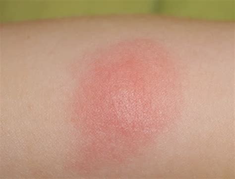 Mosquito Bites On Kids Toddler And Baby Learn How To Take Care Of