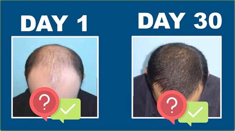 Hair Loss Remedy For Men What S The Best Solution Youtube