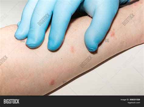 Allergic Skin Rash On Image And Photo Free Trial Bigstock