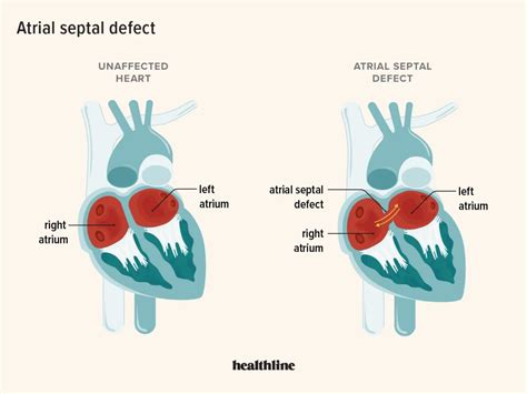 Atrial Septal Defect คืออะไร Khao Ban Muang