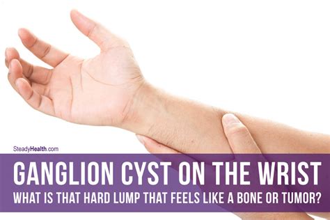 Ganglion Cyst On The Wrist What Is That Hard Lump That Feels Like A My XXX Hot Girl