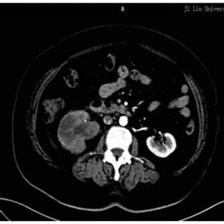 CT Scan Showing A Well Defined 23 Cm Mass Invading The Right Renal