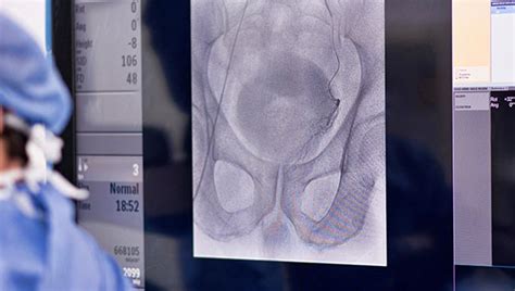 Prostate Artery Embolisation Reading Berkshire Imaging