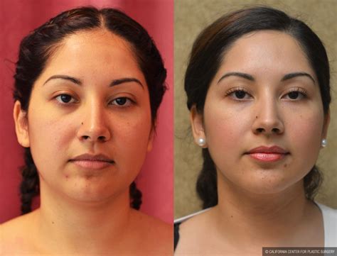 Patient Neck Face Liposuction Before And After Photos Encino