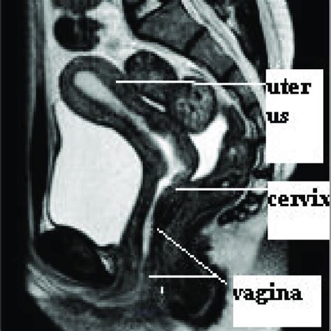 Pdf Cervical Dysgenesis With Transverse Vaginal Septum With