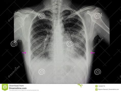 Human Lungs Pneumonia Stock Photos 193 Images