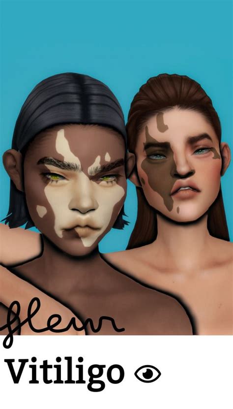 Sims 4 Mods Vitiligo Skin Mazcash