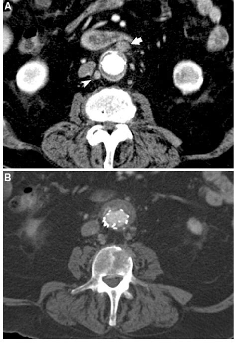 A On Follow Up Imaging Progression Of The Periaortic Lymph Nodes Was