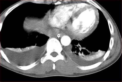 Radiology Image Spotters Bilateral Hemothorax