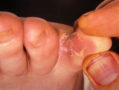 Common Foot Rashes Symptoms Causes And Treatments