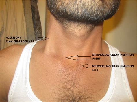 Figure 1 From Accessory Clavicular Sternocleidomastoid Causing