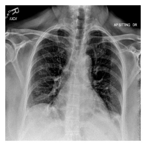 Chest X Ray Showing Hypoinflated Lung Fields With Basal Atelectasis