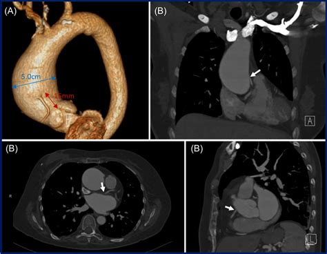 Ascending Aortic Aneurysm And Anomalous Rca Computed Tomography Ct