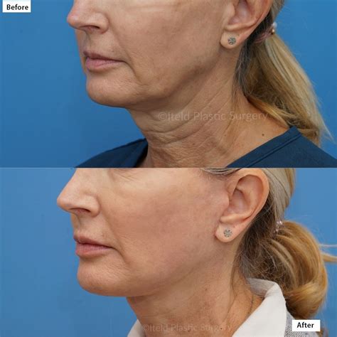 Check Out These Amazing Results Dr Iteld Achieved Doing A Facelift