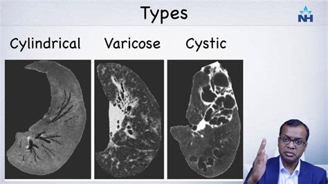 Ct Imaging And Diagnosis Of Bronchiectasis Youtube