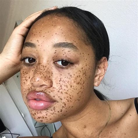 How To Get Rid Of Freckles On Lips