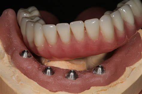 Implant Supported Dentures Longview Tx Dr Kovacs