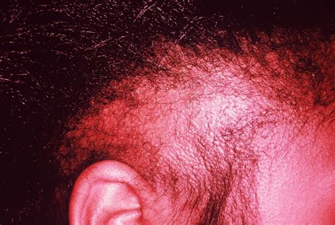 Traction Alopecia What Causes Traction Alopecia