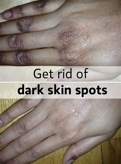 How To Get Rid Of Chemical Irritated Skin Heidi Salon