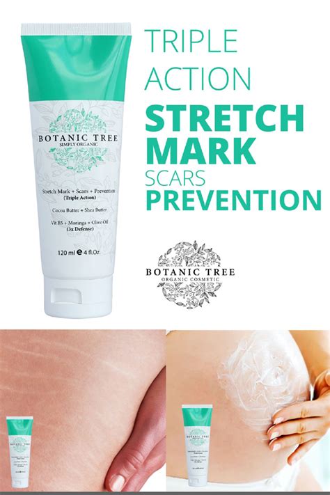 Best Stretch Marks Cream