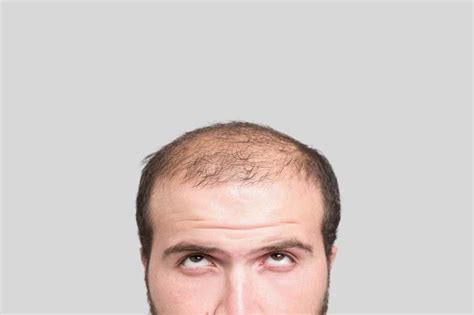 What Is Male Pattern Baldness Upmc Healthbeat